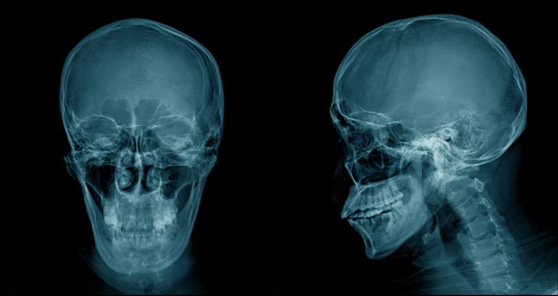 skull x-ray
